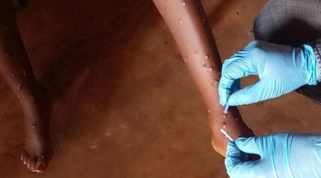 Mpox : l’OMS approuve le premier test de diagnostic pour une utilisation en situation d’urgence