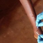 Mpox : l’OMS approuve le premier test de diagnostic pour une utilisation en situation d’urgence