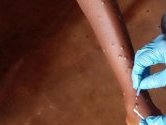 Mpox : l’OMS approuve le premier test de diagnostic pour une utilisation en situation d’urgence