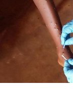 Mpox : l’OMS approuve le premier test de diagnostic pour une utilisation en situation d’urgence